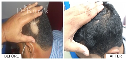 Hair Falling Treatment